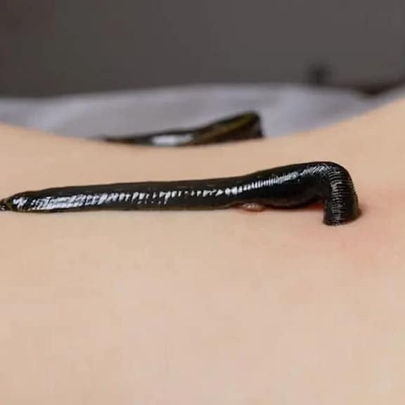 Jalukawacharana Treatment